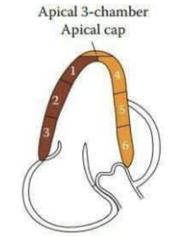 <ol><li><p>Apical lateral (LCx)</p></li><li><p>Mid inferolateral (LCx)</p></li><li><p>Basal inferolateral (LCx)</p></li><li><p>Apical anterior (LAD)</p></li><li><p>Mid anteroseptal (LAD)</p></li><li><p>Basal anteroseptal (LAD)</p></li></ol>