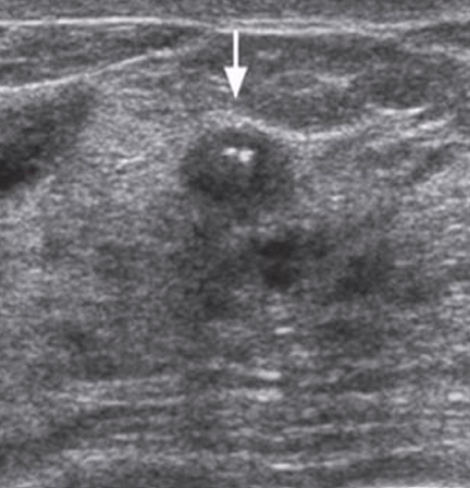 <ul><li><p><u>Most common noninvasive cancer</u><span> that has not spread beyond the milk duct, but its presentation means an increased risk in future invasive cancer</span></p></li><li><p><span>Typical cure rate - 99-100%</span></p></li></ul><p></p>