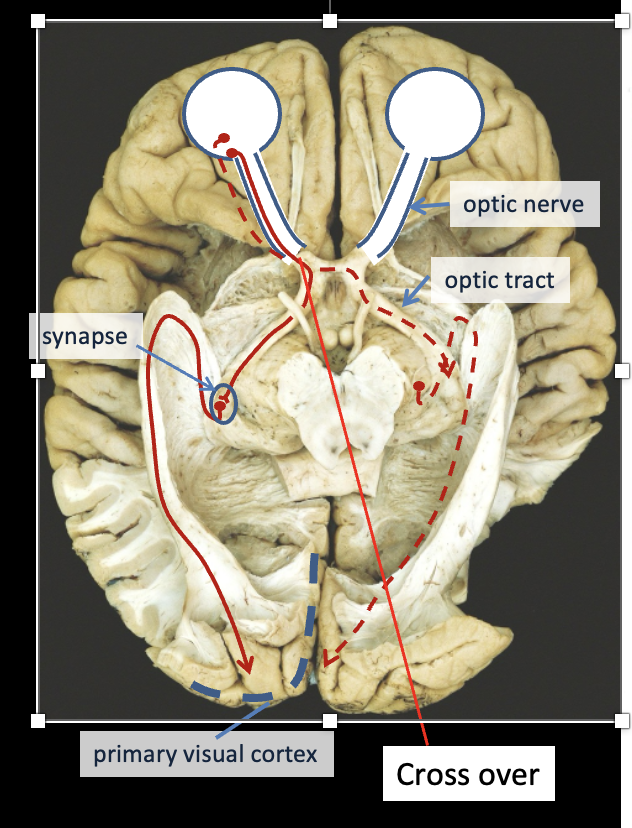 <ul><li><p><strong>Light enters the eye</strong> and hits the retina.</p></li><li><p><strong>Rods and cones</strong> in the retina convert light to electrical signals.</p></li><li><p>Signals travel along the <strong>optic nerve</strong> to the brain.</p></li><li><p>At the <strong>optic chiasm</strong>, the <strong>nasal retinal fibers cross</strong>, but the <strong>temporal fibers stay on the same side</strong>.</p></li><li><p>The information travels along the <strong>optic tract</strong> to the <strong>lateral geniculate nucleus (LGN)</strong> in the <strong>thalamus</strong>.</p></li><li><p>The LGN sends signals through the <strong>optic radiations</strong> to the <strong>primary visual cortex</strong> in the <strong>occipital lobe</strong>.</p></li></ul><p></p><p></p>