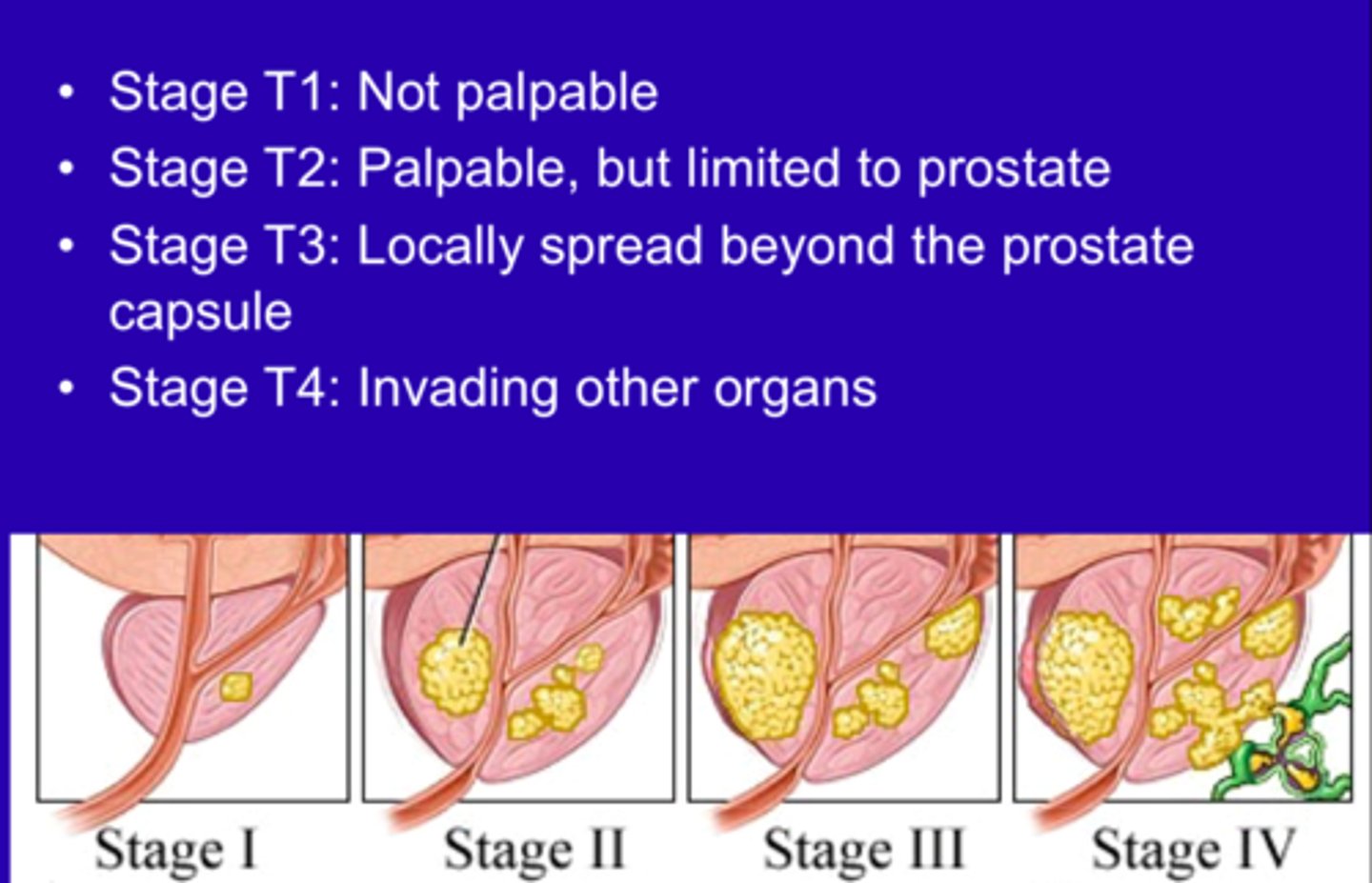 <p>cancer of the prostate gland, usually occurring in men middle-aged and older</p>