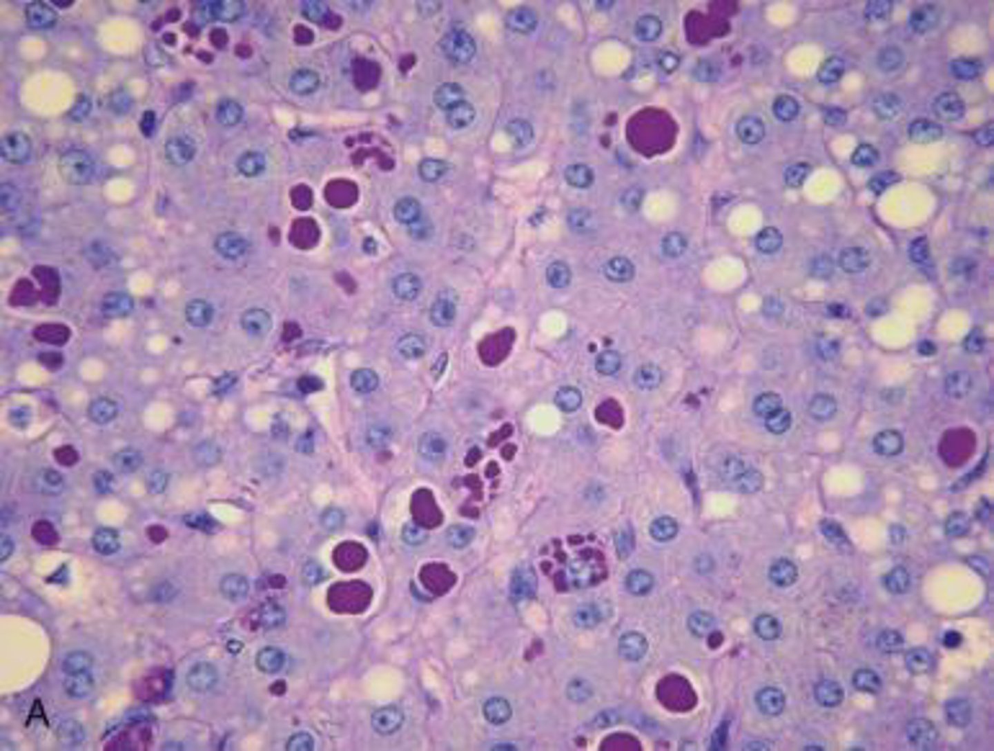 <p>PAS + globules on liver biopsy in a patient with panacinar emphysema suggests:</p>