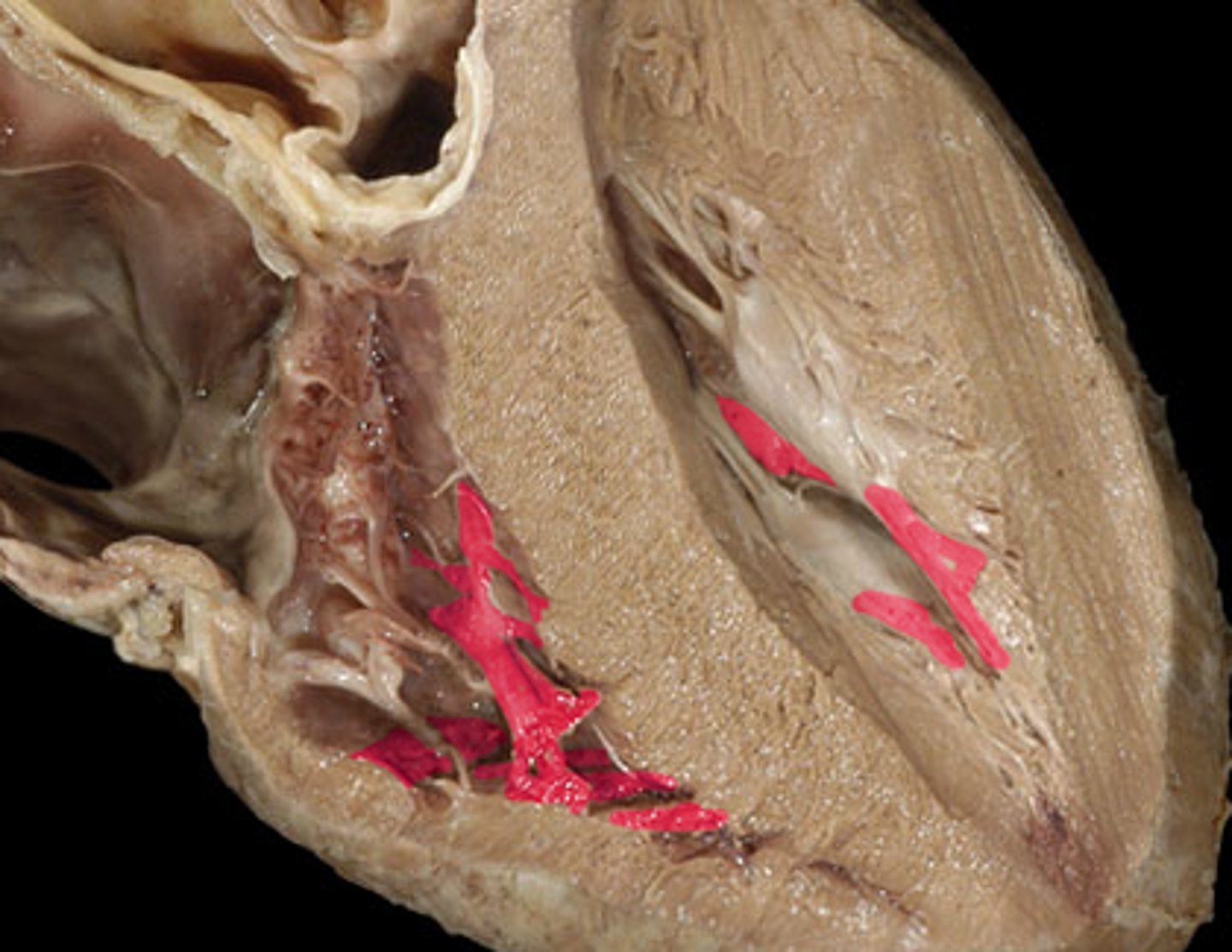 <p>muscular ridges on the internal surface of the ventricles</p>