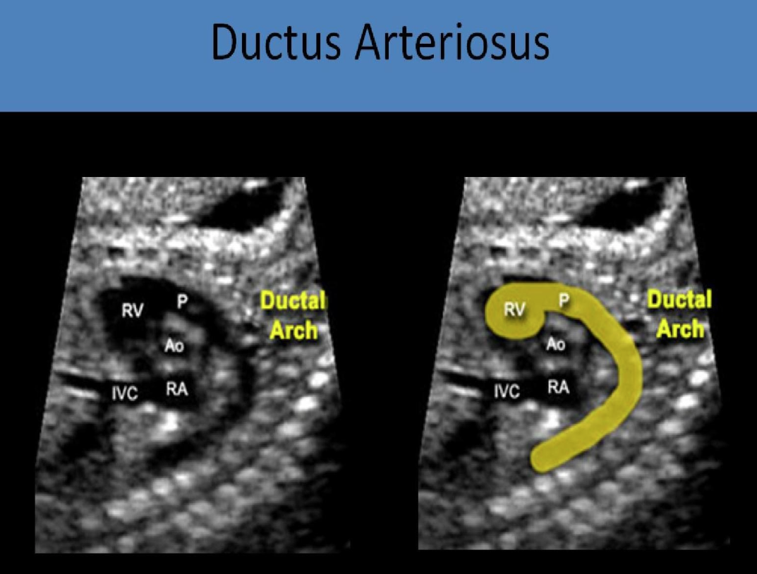 <p>Part of fetal circulation system that connects pulmonary artery to aorta and closes within 72 hours after birth to become ligamentum arteriosum</p>