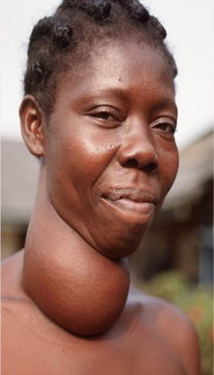 <p>_____ deficiency inhibits thyroid hormone production, causing excess TSH----&gt; excessive growth of thyroid follicles causing goiter</p>