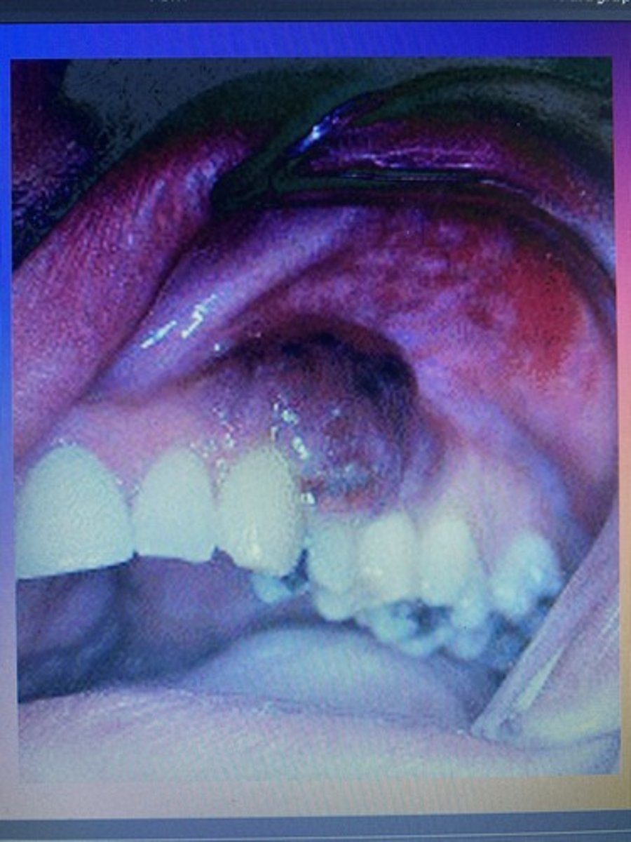 <p>This patient is HIV positive and presents with this lesion on their Gingiva. The diagnosis of this lesion is an indication that their condition is progressing into AIDS. (Two groups are at risk: elderly men mainly of Mediterranean origin and person with iatrogenic immunosuppressant)</p>