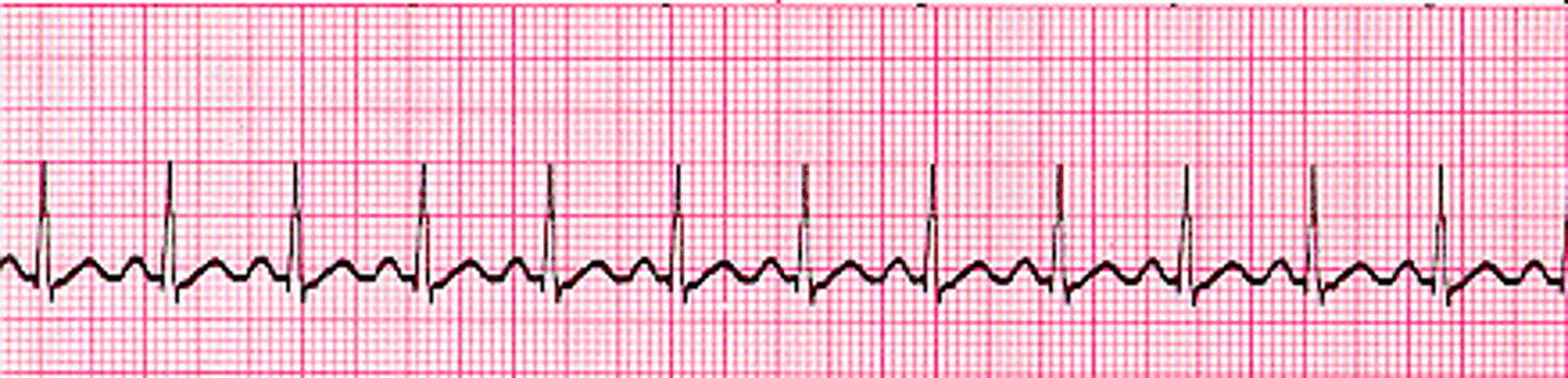 <p>rapid heart rate over 100 bpm; less than 3 big boxes; may lead to fibrillation</p>