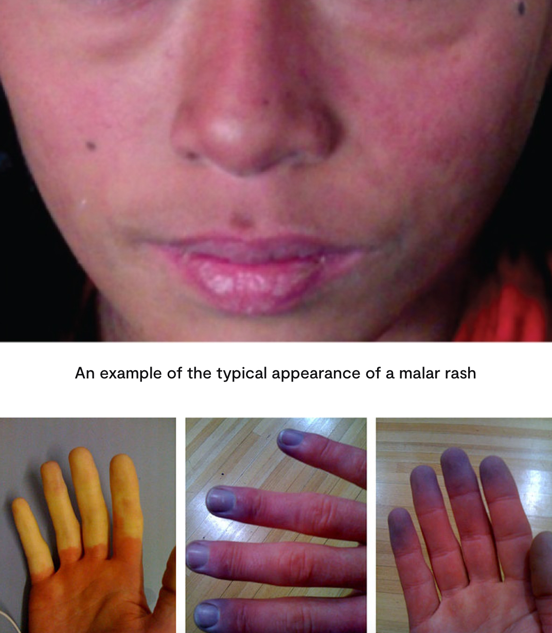 <ul><li><p><strong>Systemic</strong> - fevers, fatigue, weight loss, <strong>myalgia, malaise, mouth ulcers</strong></p></li><li><p><strong>Dermatological</strong> - <strong>photosensitivity</strong>, <strong>malar rash, </strong>discoid rash, livedo reticularis, alopecia, Raynaud's phenomenon, cutaneous vasculitis</p></li></ul><p></p><p><strong>Rash is usually photosensitive aka gets worse in sunlight </strong></p><p></p>