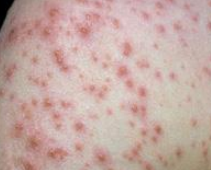 <p>Identify the descriptive term for this lesion</p>