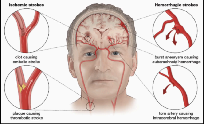 <p>Cerebrovascular Disease (CVD)</p>