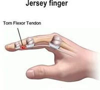 <p>C. FDP tendon<br></p>