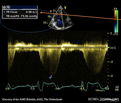 <p>TRMax PG + RAP = RVSP</p><p><span>1. Place the CW cursor through the TR color jet</span></p><p><span>2.Measure the tricuspid regurgitant waveform to achieve the tr velocity</span></p><p><span>3.The machine will use the TR Vmax velocity and turn it into a pressure gradient. This is done by using the bernoulli equation</span></p>
