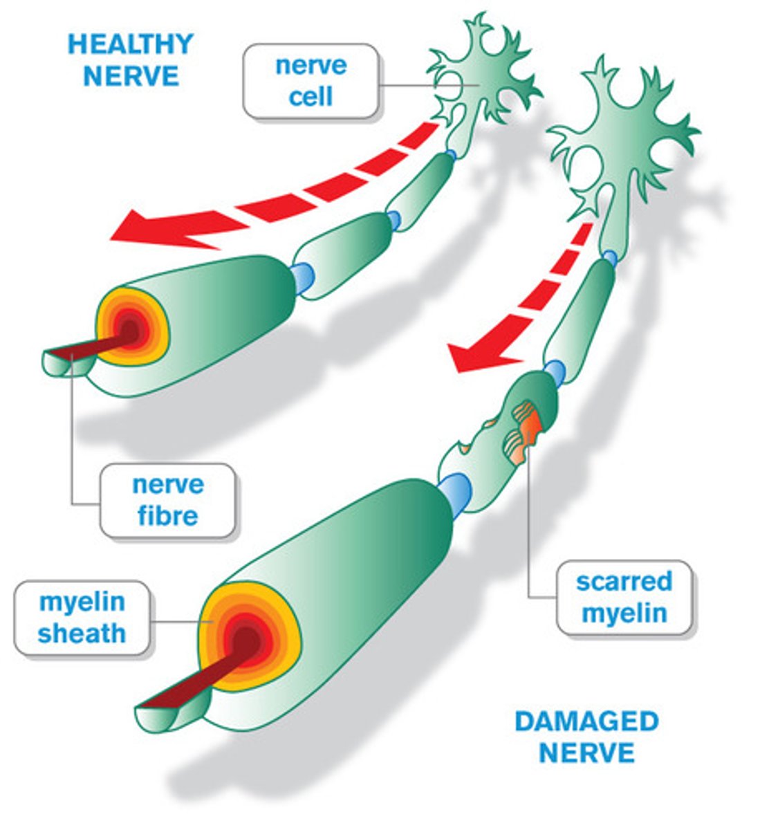 <p>myelin sheath destruction. disruptions in nerve impulse conduction</p>