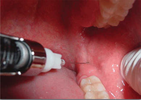 <p>about 1/3-1/2 the length of a long needle</p>