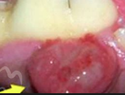 <p><strong>Summary table for oral tumors in dogs</strong></p><ol><li><p>frequency = 5%</p></li><li><p>median age yrs = 8 yrs</p></li><li><p>site predilection = rostral mandible</p></li><li><p>LN mets = none</p></li><li><p>distant mets = none</p></li><li><p>gross appearance = red, cauliflower, ulcerated</p></li><li><p>Sx response = excellent :)</p></li><li><p>RT response = excellent</p></li><li><p>Best tx = surgery</p></li><li><p>Cause of death = rarely tumor related </p></li></ol><p></p>