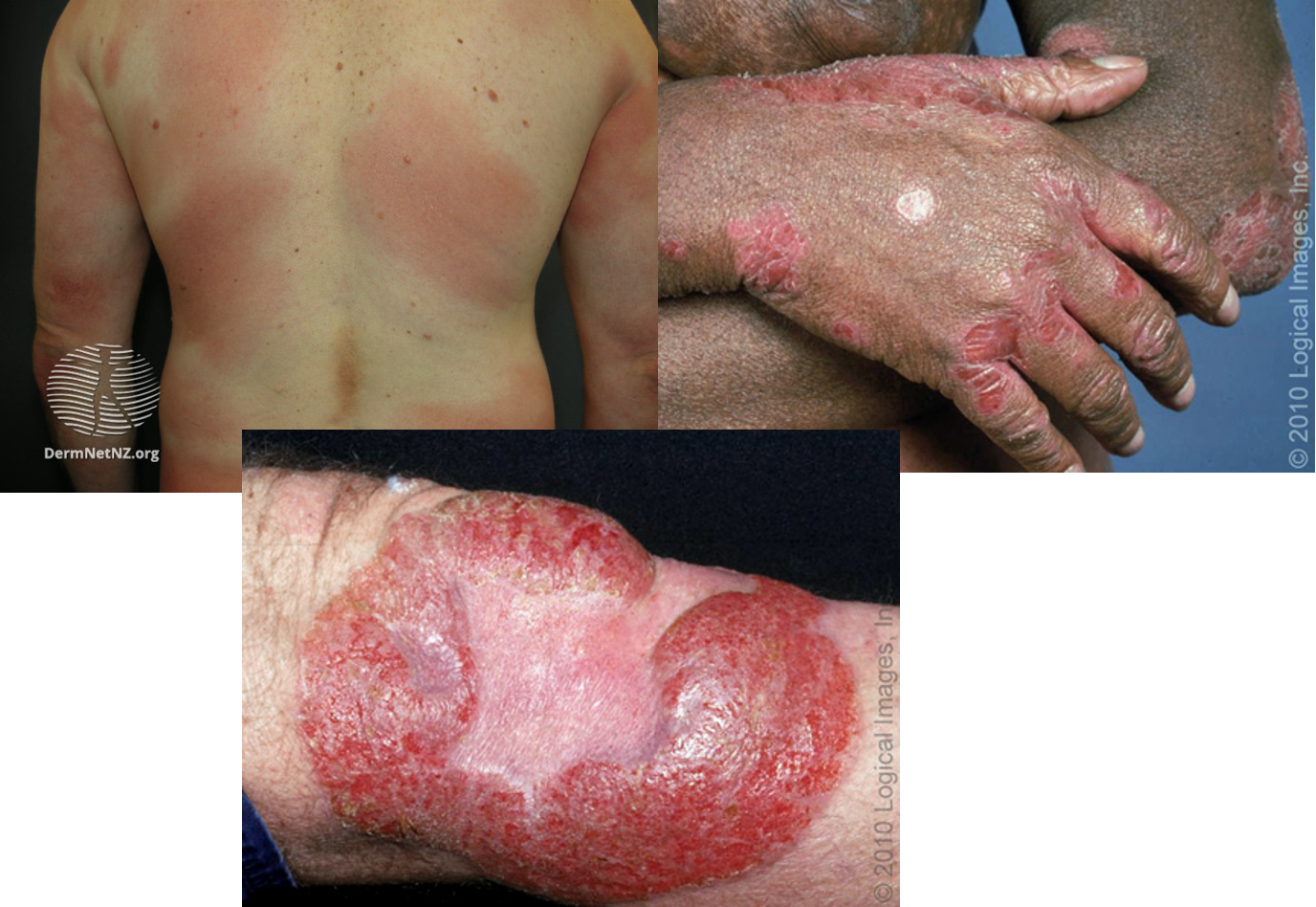 <ul><li><p>presents as chronic itch (even before clinical signs)</p></li><li><p>patch stage: poorly defined, irregular scaling red patches</p><ul><li><p>hypopigmented variant- pale, finely scaly patches</p></li></ul></li><li><p>plaques stage: well demarcated, annular itchy thickened lesions w/ red, violet, or brown color</p></li><li><p>tumor stage: large irregular lumps (&gt;1cm) developing from plaques</p></li></ul><p></p>