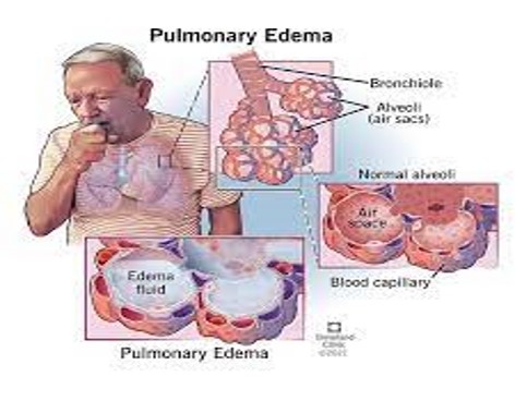 <p>Replacement of air with fluid in the lung interstitium and alveoli </p>