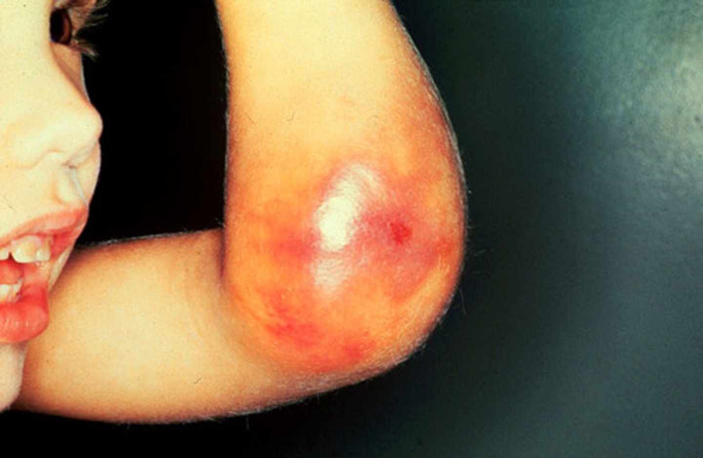 <p>bleeding into a joint space</p><p>- sign of hemophilia A</p>