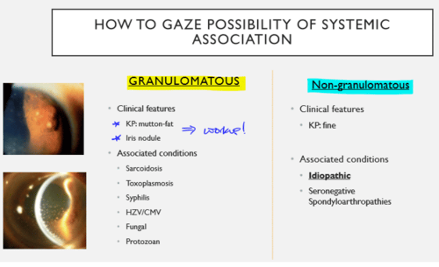 <p>Granulomatous:</p><p>- KP: mutton fat</p><p>- Iris nodule</p><p>Non-Granulomatous:</p><p>- KP: fine</p>
