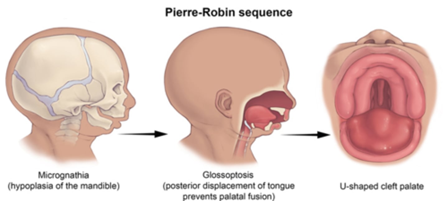 <p>Pierre Robin Sequence involves the first arch</p>