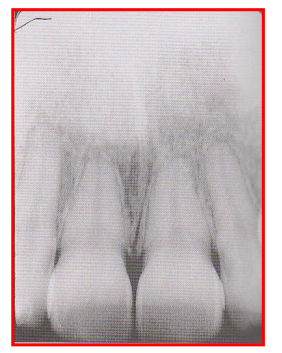 <ul><li><p>Teeth appear short with blunted roots; image looks shorter than actual tooth </p><ul><li><p>Reason: Excessive vertical angulation of the PID </p></li></ul></li><li><p>Fix: Flatten the angle of the PID </p></li></ul><p></p>