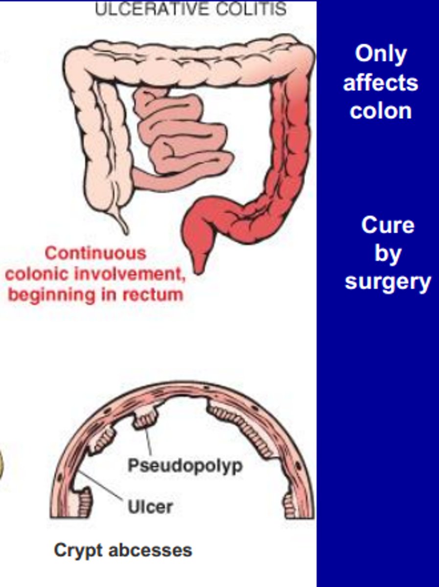 <p>(UC)</p><p>mucosal inflammatory condition</p><p>confined to rectum and colon</p>