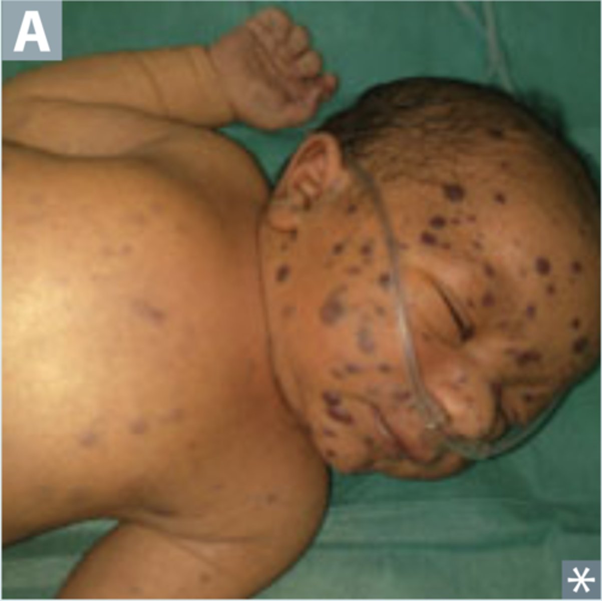 <p>extramedullary hematopoiesis in the dermis</p>