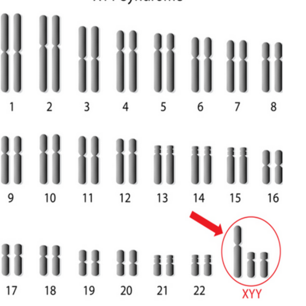 <p>Based on the set of chromosomes shown, what syndrome does this person have?</p>