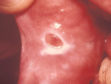 <p>What is the management of a traumatic ulcer?</p>