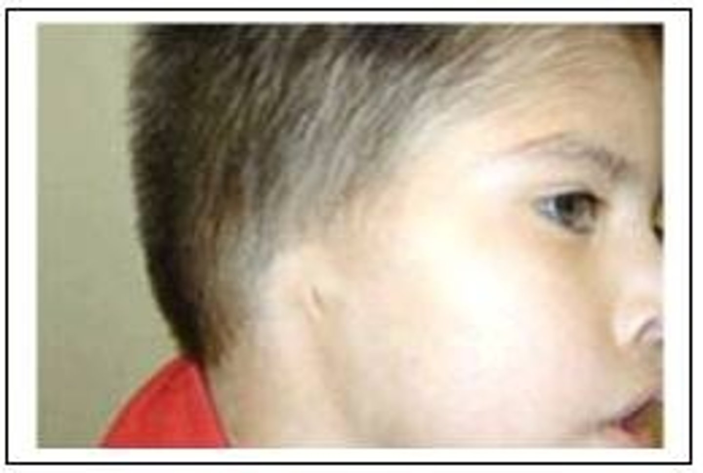 <p>Abnormal absence of the outer ear and/or closure of the ear canal.</p>