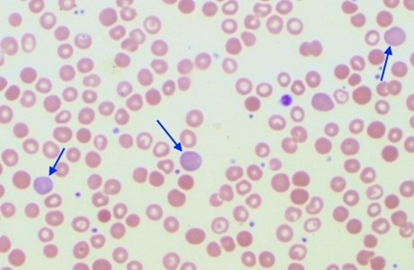 <p>Various anemias, normal newborn</p>