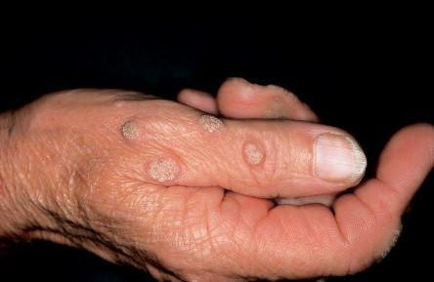 <p>treatment for which benign epithelial lesion:</p><p>• Surgical excision</p><p>• 2/3 disappear spontaneously</p><p>with no treatment</p><p>• No malignant transformation</p>