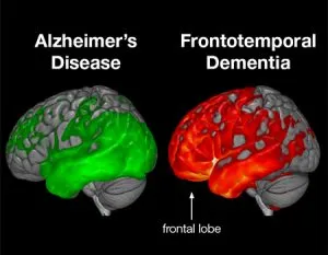 <p>Frontotemporal dementia (FTD)</p>