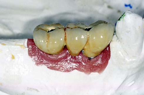 <p>What are considerations for soft tissue moulage? When is it removed?</p>