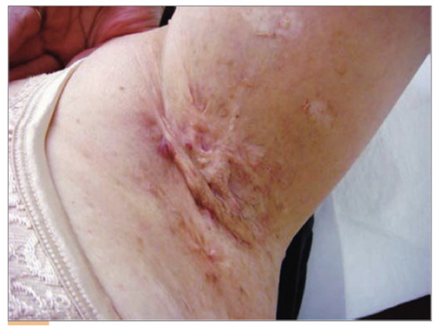 <p>PE:</p><p>Initial lesion is very tender, red, inflammatory nodules/abscess that may resolve on its own or require tx</p><p>Tender sinus tracts forms</p><p>Fibrosis and hypertrophied scars can form</p>