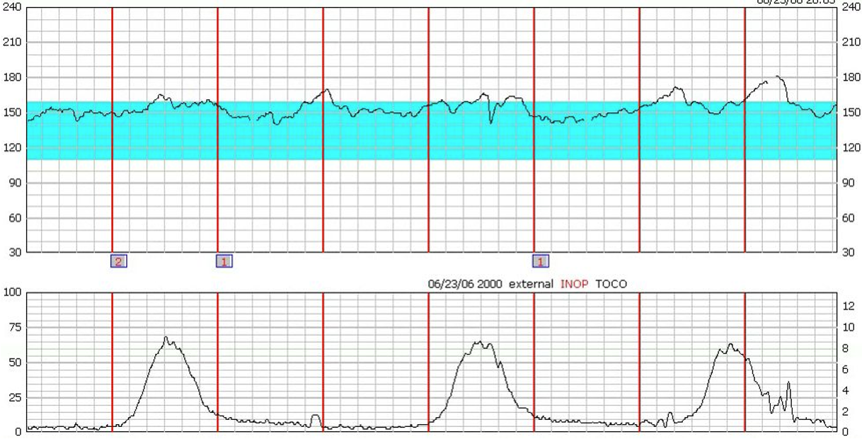 <ul><li><p>Average heart rate over a 10 minute window</p><ul><li><p>Normal range: 110-160 bpm</p></li></ul></li><li><p>Baseline reflects the fetus’s overall:</p><ul><li><p>Oxygenation</p></li><li><p>Neurological status</p></li><li><p>Autonomic nervous system</p></li></ul></li><li><p>Excludes accelerations and decelerations</p></li></ul><p></p><p></p>