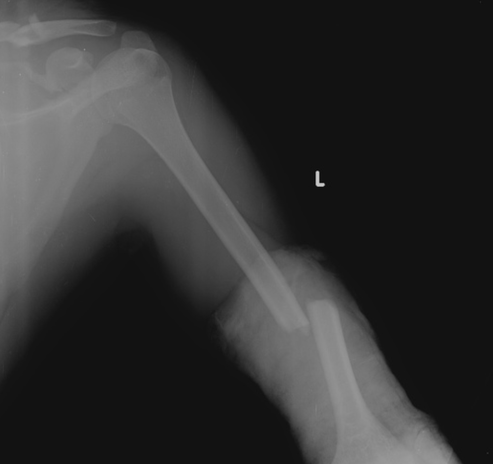 <p>Non-operative management for humeral shaft fractures (takes 3+ months to heal)</p>