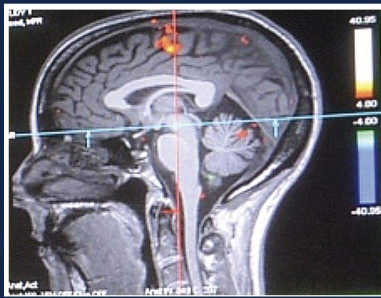 * Studying the activity of nervous system areas 
* allows us to correlate brain activity with the presentation of a stimulus, the presence of an emotional state, or the performance of a particular task in living humans 
  * uses a series of images taken in a short period of time to analyze brain activity 