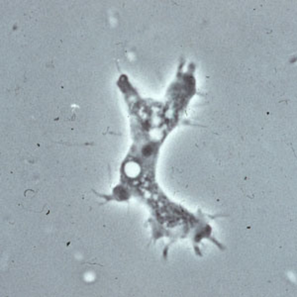 <p>Define CNS Infection Cause:</p><p>-Amebic Infection</p><p>-Chronic granulomatous disease </p>