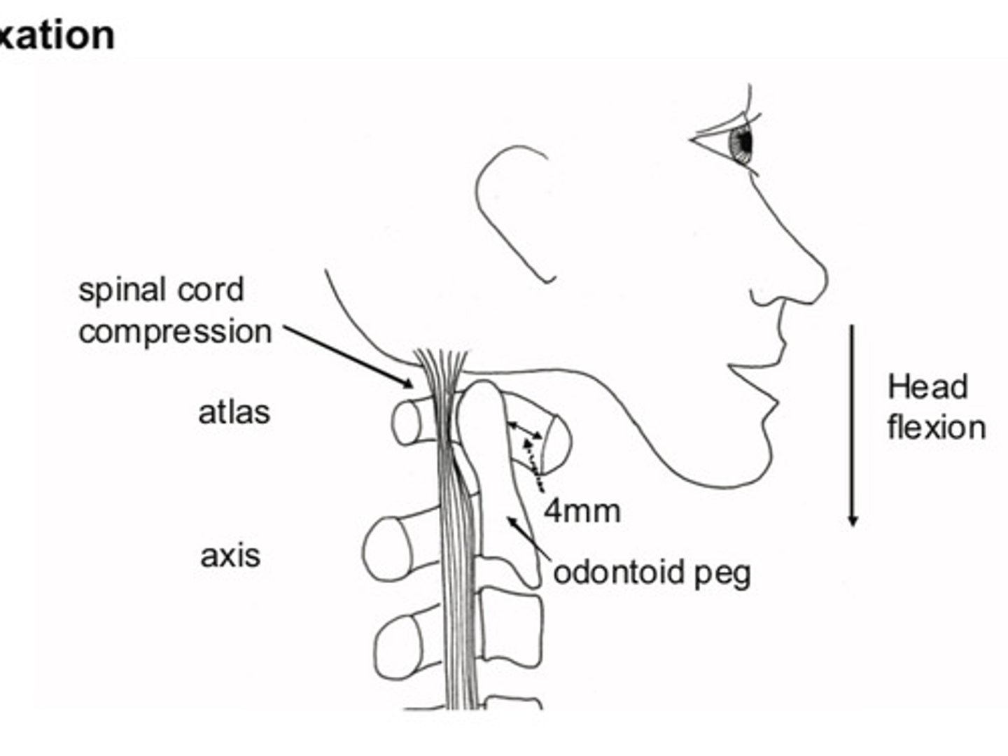 <p>Tendons at the top of the cervical spine can be weakened by rheumatoid tenosynovitis</p><p>If odontoid peg subluxation backwards over days or week = compress upper cervical cord = progressive spastic tetraparesis</p><p>Sudden = rapid output of inhibitory impulses down vagus +/- cardiac arrest</p>