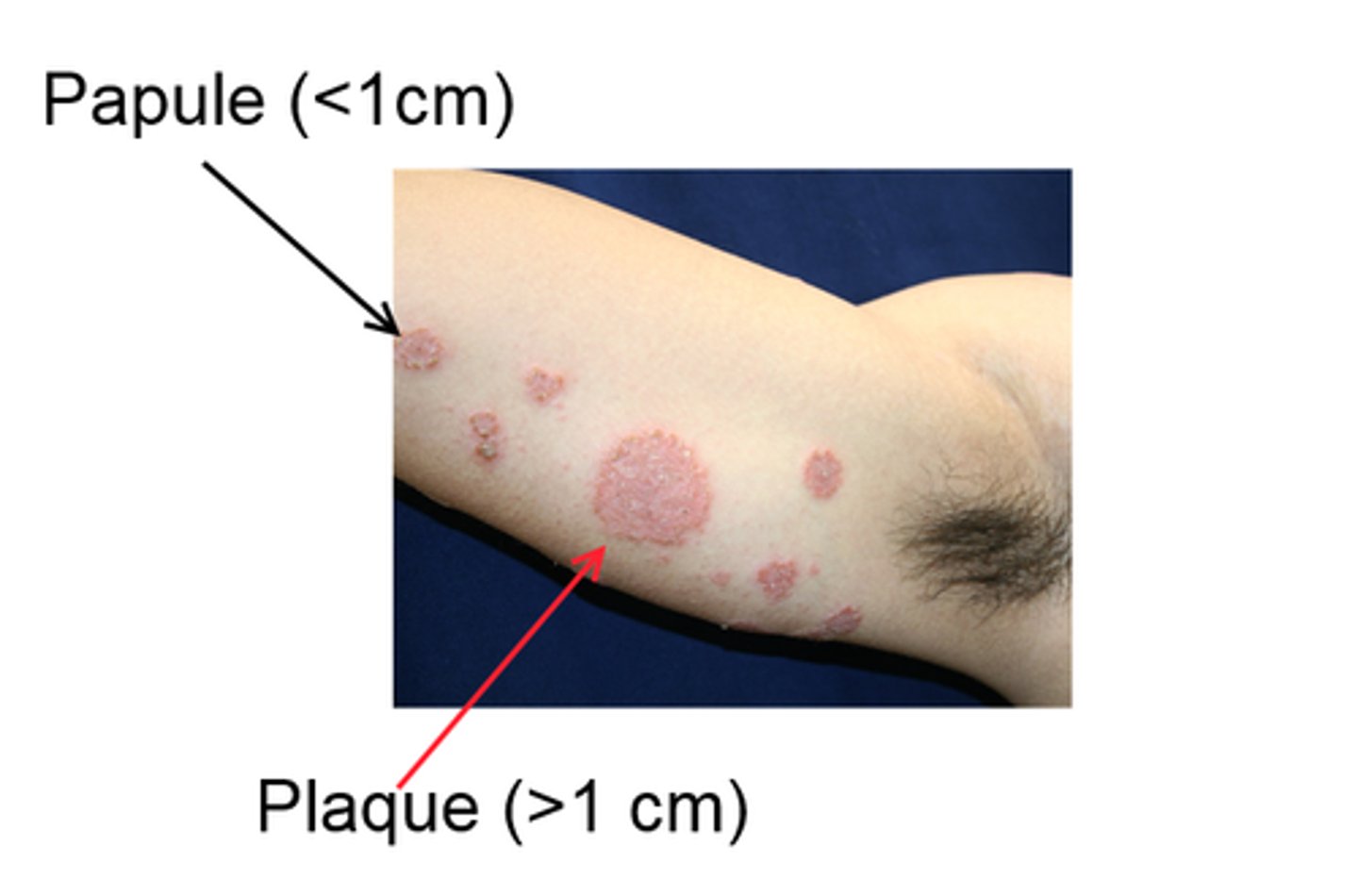 <p>Papule</p>
