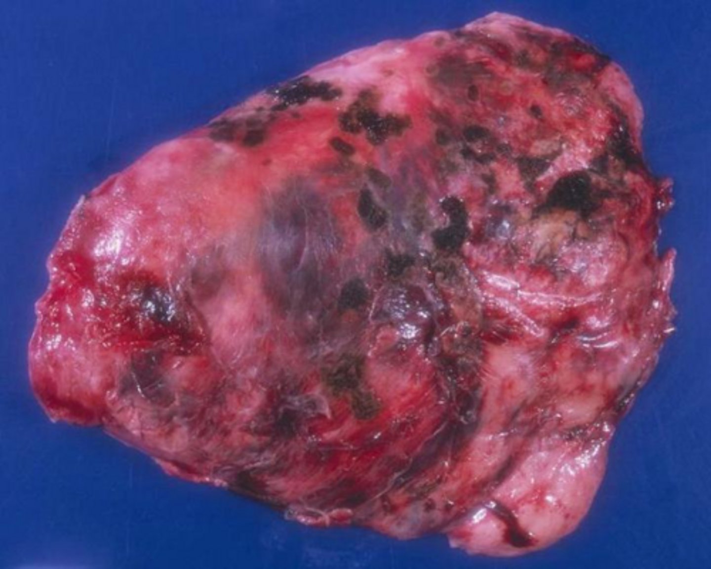 <p>Alveolar walls break down, resulting in larger but fewer alveoli and reduced lung elasticity.</p>