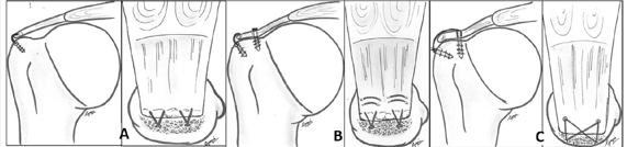 <p>With Arthroscopic Rotator Cuff repair, C is best because</p>