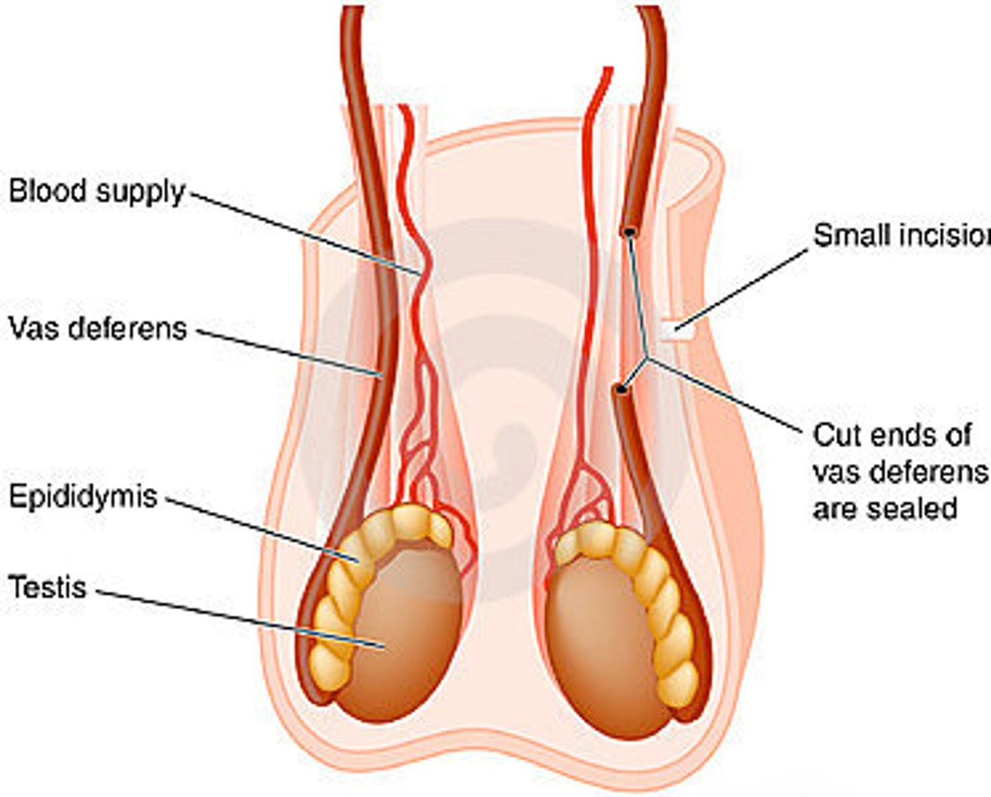 <p>creation of artificial openings between ducts (the severed ends of the vas deferens are reconnected in an attempt to restore fertility in men who have had a vasectomy)</p>