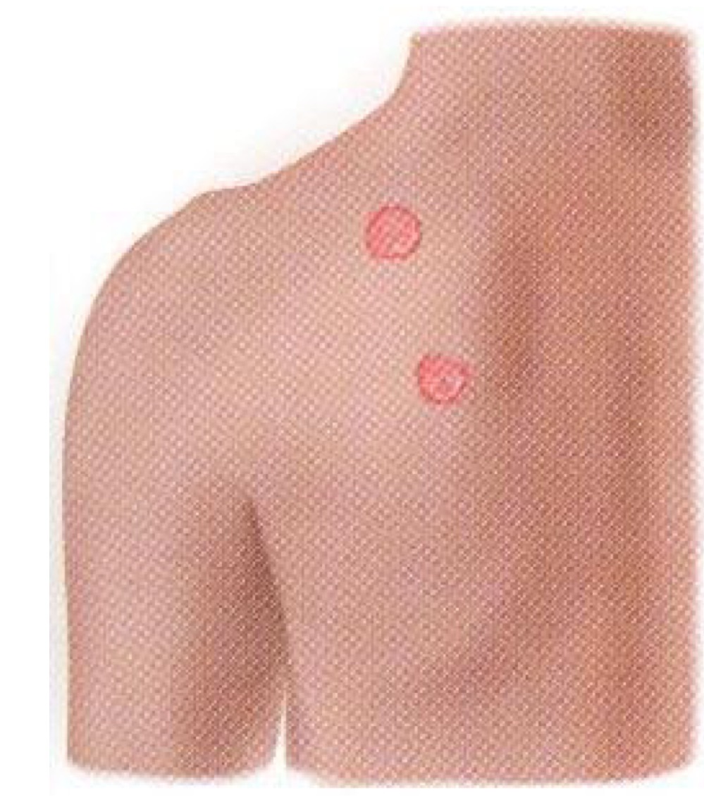 <p>what pattern of skin lesion is this? </p>