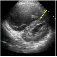 <p>What is PSAX D sign?</p><p>*for R. heart strain → PE</p>