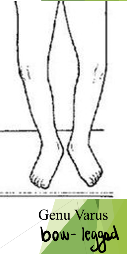 <p>Bow-legged</p><ul><li><p>Femoral shaft < 10º from vertical. </p></li><li><p>Increased weight bearing on the medial femoral condyle and medial tibial plateau– sites for DJD. </p></li></ul><p></p>