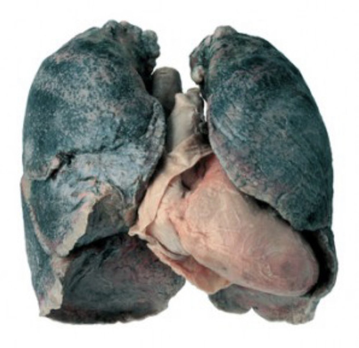 <p>Inhalation of coal dust leads to significant scarring &amp; fibrosis</p>