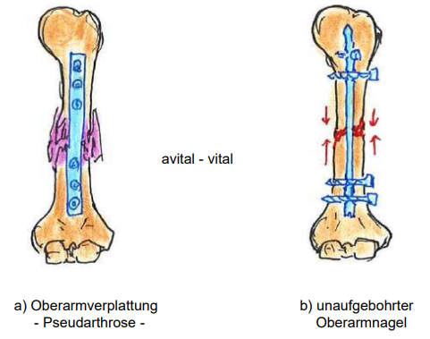 <ul><li><p>stabile Osteosynthese</p></li><li><p>Anfrischen der Pseudarthrose</p></li><li><p>Spongiosaplastik (schwammknochen, Knochentransplantation)</p></li><li><p>Infektionssanierung mit Sequesterentfernung (toten Knochen entfernen)</p></li><li><p>Ultraschall hilft evt. auch</p></li></ul><p></p>