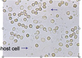 <ul><li><p class="">Seen in <strong>dilute (hypotonic) urine</strong></p></li><li><p class=""><strong>RBCs swell and lyse</strong>, but membranes remain <strong>intact</strong></p></li><li><p class="">Appear as <strong>empty, faint outlines</strong></p></li><li><p class=""><strong>Do not count</strong> in RBC estimate — just <strong>note as “present”</strong></p></li></ul><p class=""></p><p class=""><strong>Contextual note</strong>:<br>Ghost cells result from osmotic lysis and may indicate prolonged urine dwell time in hypotonic conditions. Their presence helps explain low RBC counts when hematuria is suspected.</p>