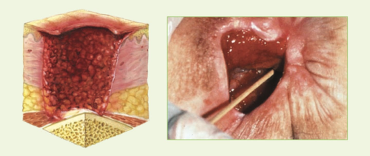 <p>Full-thickness skin loss with damage to bone, muscle, or supporting structures</p>